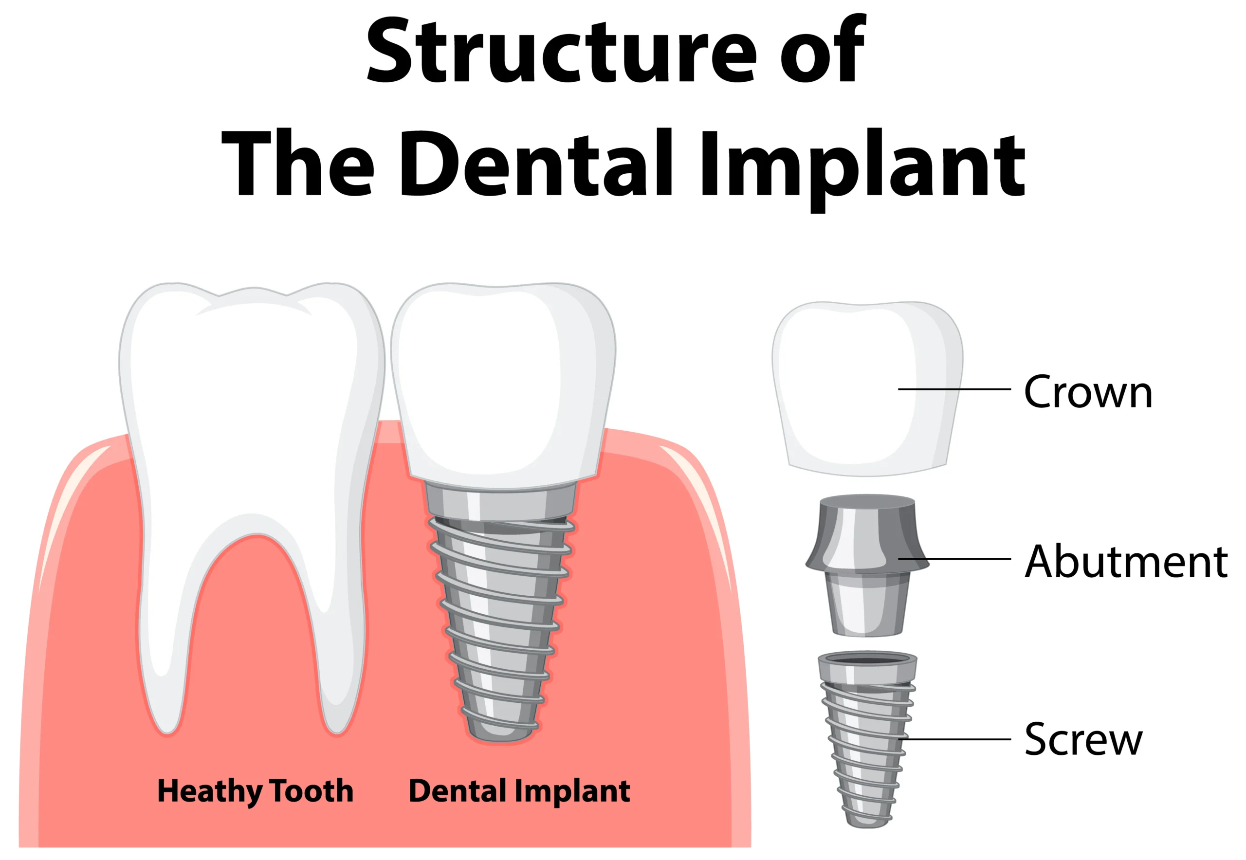 dental implants