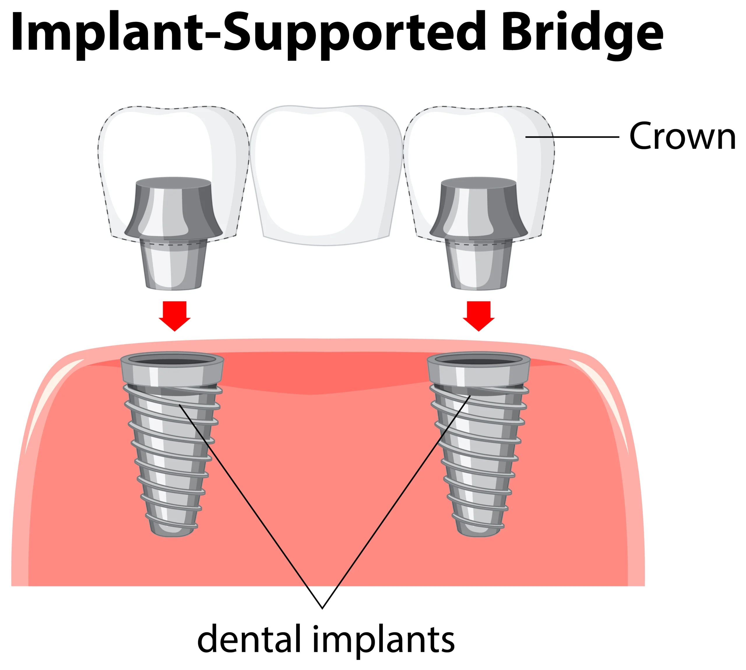 dental implants